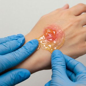 Chữa bỏng bằng mật ong Phương pháp dân gian đơn giản