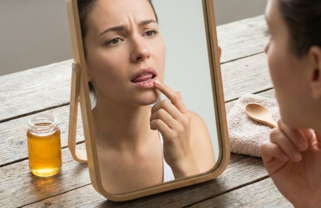 Lưu ý khi dưỡng môi bằng mật ong